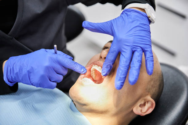 Best Knocked-Out Tooth (Avulsed Tooth) Treatment in Sunset, LA